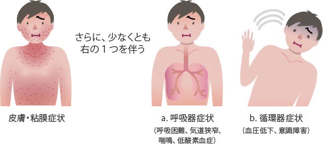 投与方法_アナフィラキシーの診断基準1