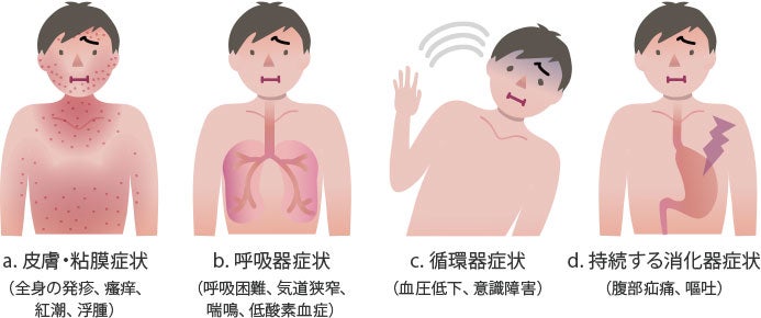 投与方法_アナフィラキシーの診断基準2