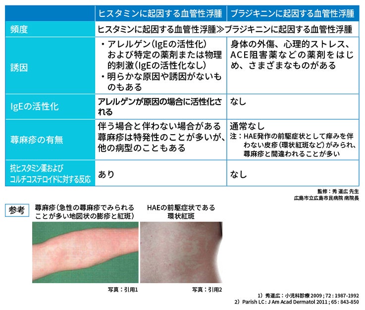 表2 ヒスタミンに起因する血管性浮腫とブラジキニンに起因する血管性浮腫の主な違い