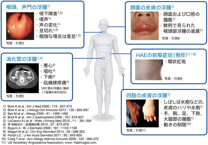 図１ 発作部位別のHAEの症状